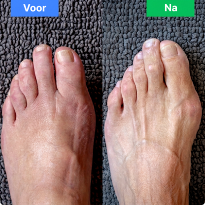 ReviveStep – Innovatieve Voetmassagebandage